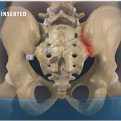 Sacroiliac Joint Steroid Injection2